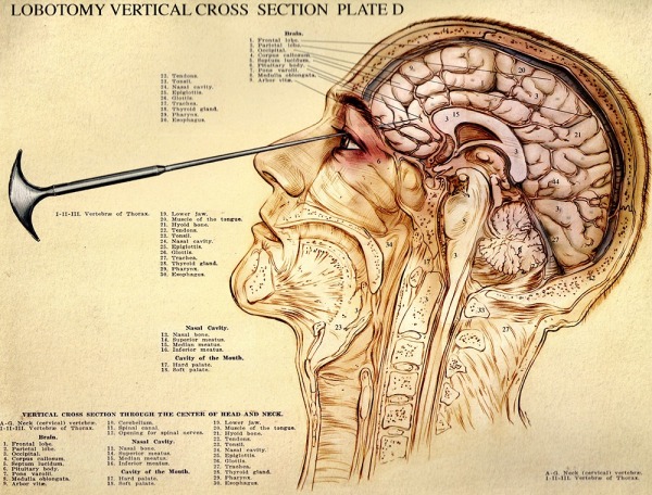 lobotomy_by_concern_trolling